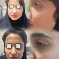 لیزر فیلر بوتاکس چربی