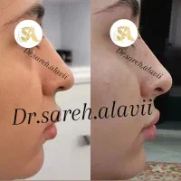 اصلاح فرم و کوچک کردن بینی توسط پزشک بدون جراحی|خدمات آرایشگری و زیبایی|قم, دورشهر|دیوار