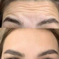 خدمات ساکشن شکم/پهلو/غبغب(تزریق چربی صورت)