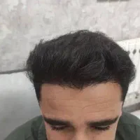 آموزش کاشت مو قیمت مناسب