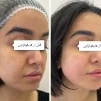 جوانسازی و لیفت پوست بدون جراحی با قویترین هایفو|خدمات آرایشگری و زیبایی|کرج, فاز ۲ مهرشهر|دیوار
