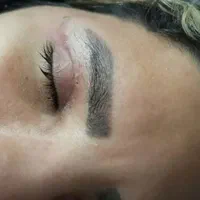جشنواره بلفاروپلاستی با بخیه لیزری،لیفت شقیقه و..|خدمات آرایشگری و زیبایی|مشهد, کوه سنگی|دیوار