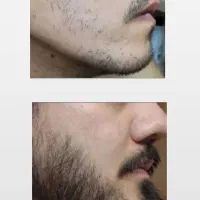 رویش سریع ریش و سیبیل