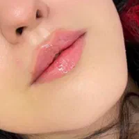 آموزش و تزریق تمامی تزریقات ژل بوتاکس