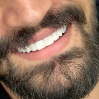 کامپوزیت دندان