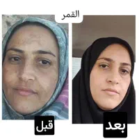 کرم القمر سفید کننده فوری