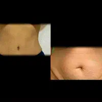 ساکشن شکم پهلو غبغب تزریق چربی ژل بوتاکس|خدمات آرایشگری و زیبایی|کرمانشاه, |دیوار