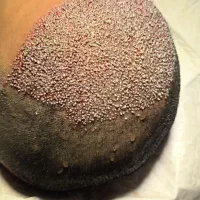 کاشت مو،ابرو و ریش|خدمات آرایشگری و زیبایی|پاوه, |دیوار