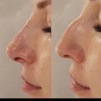 تزریق ژل،بوتاکس درمکانی مستقل بارعایت اصول بهداشتی|خدمات آرایشگری و زیبایی|زاهدان, |دیوار