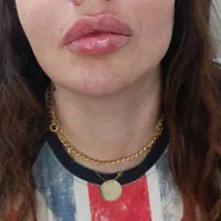 بوتاکس چشم گربه ای|خدمات آرایشگری و زیبایی|تهران, سازمان برنامه شمالی|دیوار