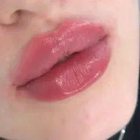 آف ویژه خدمات ژل و بوتاکس برای خانم ها و آقایون