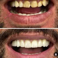 کامپوزیت|خدمات آرایشگری و زیبایی|آزادشهر, |دیوار