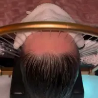 آموزش اسکراب اسکالپ سر (اقساطی)