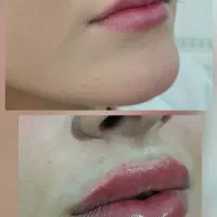 خدمات ژل بوتاکس خانما و آقایون