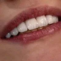 مدل کامپوزیت دندان