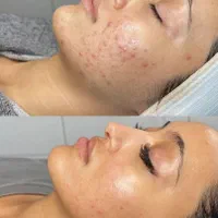 لیزر خال برداری.جوانسازی شهرری|خدمات آرایشگری و زیبایی|ری, جوانمرد قصاب|دیوار