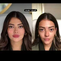 نخ کل صورت 55000فیلر 690بوتاکس 690