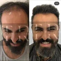 جشنواره کاشت مو در تهران|خدمات آرایشگری و زیبایی|قم, باغ پنبه|دیوار