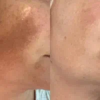 پک جوانسازی پوست ودرمان لک واکنه