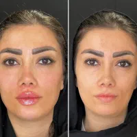 تزریق ژل لب،بوتاکس،زاویه سازی|خدمات زیبایی و سلامت|کرج, جهانشهر|دیوار