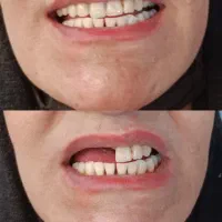 دندانسازی (دندان مصنوعی)