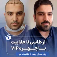 کاشت مو در یکروز|خدمات آرایشگری و زیبایی|تهران, گاندی|دیوار