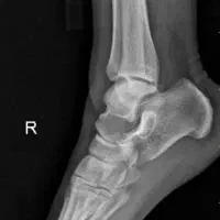 درمان دیسک کمر و گردن