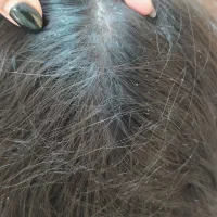 پاکسازی قطعی و تضمینی رشک وشپش گرگان وحومه