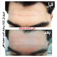 آموزش وارائه خدمات ژل و بوتاکس و فیلربادی(ژل بدن)|خدمات آرایشگری و زیبایی|جهرم, |دیوار
