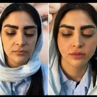 زاویه سازی.ژل.فیلر.نخ.انزیم مزو بوتاکس دکتر داریوش