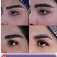 بلفاروپلاستی تخفیف ویژه شب یلدا