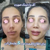 تزریقات زیبایی فیلروبوتاکس،مزوتراپی،جوانسازی