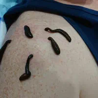 زالو درمانی و حجامت درطب سنتی با ۸ سال سابقه کار|خدمات آرایشگری و زیبایی|سبزوار, شرق کال میانی|دیوار