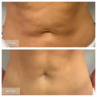 اندولیفت شکم/اندولیفت بازو/درمان سلولیت پشت ران