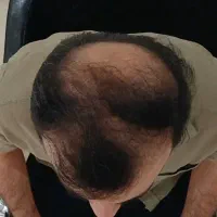 کاشت موی طبیعی فول تراکم|خدمات آرایشگری و زیبایی|ساری, |دیوار