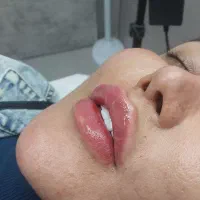 اموزش تزریقات زیبایی بوتاکس و فیلر و مزو