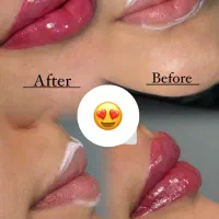 تخفیفات جمعه سیاه با بوتاکس رایگان توسط پزشک|خدمات آرایشگری و زیبایی|قم, هفت تیر|دیوار