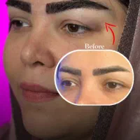 کاشت ابرو همراه با ضمانتنامه کتبی