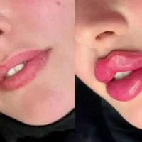 فیلر. بوتاکس.لیفت نخ.ساکشن کوچیک کردن بینی کلینیک