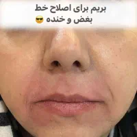ژل لب فیلر بوتاکس مزو وآنزیم          زیرنظرپزشک|خدمات آرایشگری و زیبایی|مشهد, آزادشهر|دیوار