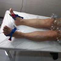 ماساژ حجامت فصدخون فیزیوتراپی بادکش درمانی