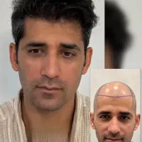 کاشت مو ابرو ریش تارکوب