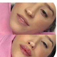 فیلرلب، ژل گونه ،انزیم، بوتاکس