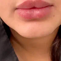 خدمات زیبایی تزریق فیلر بوتاکس