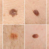 برداشتن خال زگیل گوشت اضاف برداشت زگیل تناسلی|خدمات آرایشگری و زیبایی|شیراز, معالی‌آباد|دیوار