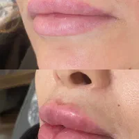 تخفیف۵۰٪ بوتاکس و فیلر (فقط یک هفته)|خدمات آرایشگری و زیبایی|ری, شهرری|دیوار