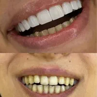 جشنواره دندانپزشکی با اقساط ویژه|خدمات آرایشگری و زیبایی|قم, شهرک فاطمیه|دیوار