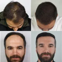 خدمات کاشت مو و ابرو به صورت اقساط|خدمات آرایشگری و زیبایی|شیراز, معالی‌آباد|دیوار