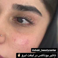 مدل بوتاکس و پی ار پی و کانتورینگ صورت با فیلر|خدمات آرایشگری و زیبایی|اصفهان, ملک‌شهر|دیوار
