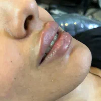 ژل و بوتاکس|خدمات آرایشگری و زیبایی|مشهد, ایثار|دیوار